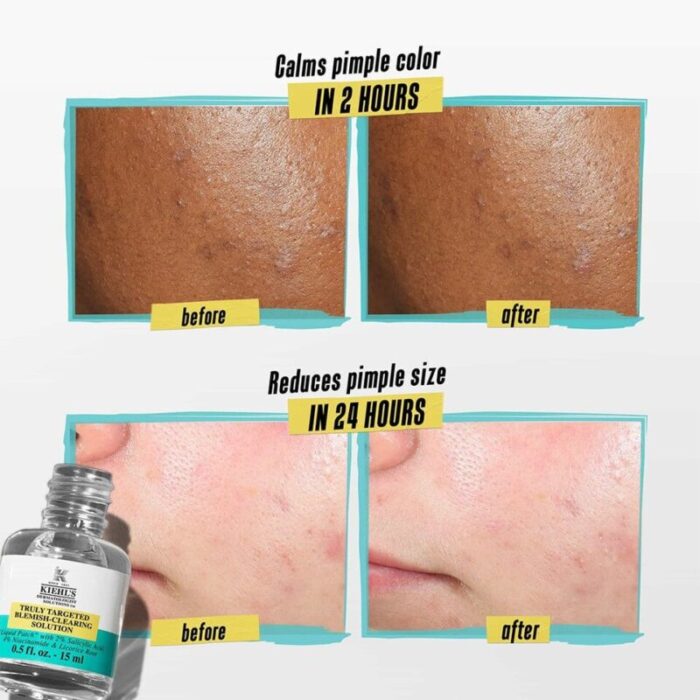 truly targeted blemish clearing solution 15ml 240707091537 2